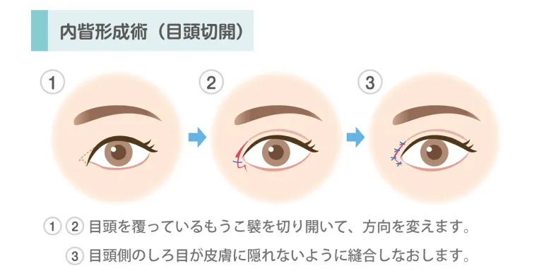 内眥形成術（目頭切開）