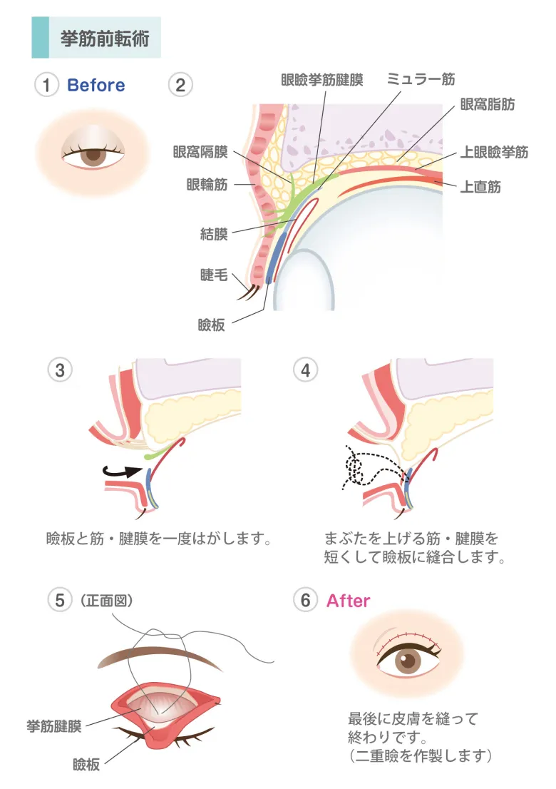 挙筋前転術